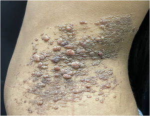 Linfangioma circunscrito. Pápulas eritemato‐acastanhadas e vesículas translúcidas confluindo em placa irregular, de aproximadamente 20cm, no flanco esquerdo