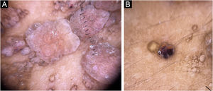 Dermatoscopia. (A) Padrão de lacunas rosas com septos pálidos. (B) Padrão lacunar com achado “hipopio‐símile”