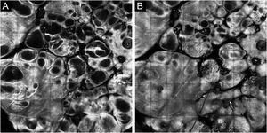 Microscopia confocal. (A) Cavidades escuras na derme superficial, com bordas bem delimitadas de alta refração. (B) Cavidades escuras na epiderme, com pequenos pontos brilhantes em seu interior
