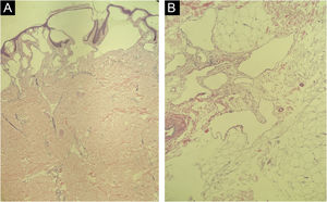 Histopatologia. (A) Proliferação e dilatação de vasos linfáticos na derme papilar. (B) Dilatação de vasos linfáticos no tecido subcutâneo