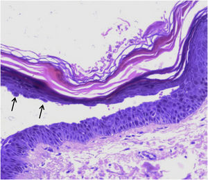 Microscopia óptica com clivagem intraepidérmica alta e queratinócitos acantolíticos (setas). Hematoxilina & eosina, 200×