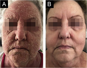 (A) Descamação de toda a face antes do tratamento. (B) Resolução completa com a terapêutica