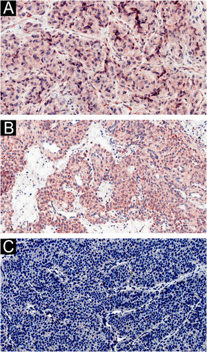 Imagens representativas da marcação imuno‐histoquímica de amostras de tumor glômico. (A) IL‐1β foi fortemente expressa em células glômicas (200×). (B) IL‐6 foi fortemente expressa em células glômicas (200×). (C) CGRP não foi expresso em células glômicas (200×).