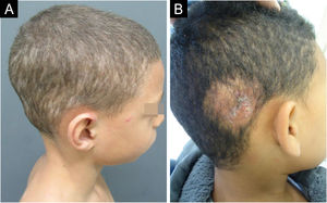 (A) Tinha do couro cabeludo, forma clínica tonsurante tricofítica. (B) Tinha do couro cabeludo, forma clínica inflamatória kerium celsi.