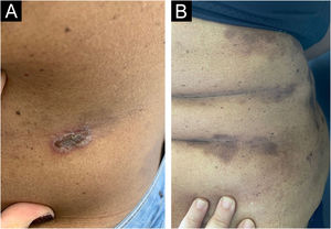 Abdome antes (A) e depois (B) de oito semanas de tratamento. Diminuição considerável das placas crostosas e bolhas, com predomínio de hipercromia residual ao final do tratamento.