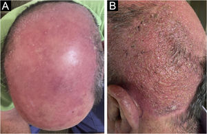 Aspecto clínico após a terapêutica. com eritema residual (A); com alopecia residual (B).
