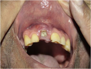 Abscesso dentário antes de iniciar imunobiológico.