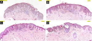 Histopatologia na coloração pela Hematoxilina & eosina de quatro lesões diferentes (A‐D). Nevos de Spitz juncionais simétricos sem atipia/com atipia de pequeno grau.