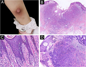 (A) Nódulo rosado com superfície ulcerada na parte interna da perna esquerda. (B) Lesão ulcerada infiltrativa (Hematoxilina & eosina, 10×). C, Proliferação de melanócitos com núcleos angulados em padrão lentiginoso (Hematoxilina & eosina, 200×). (D) Hiperplasia pseudoepiteliomatosa e melanócitos epitelioides parcialmente agrupados em ninhos na derme superior (Hematoxilina & eosina, 40×).