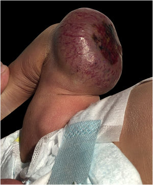 Tumor vascular de 10×9cm, imagem obtida ao nascimento; placa necrótica ulcerada é observada na superfície do tumor, localizado na coxa D.