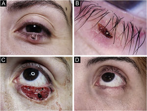 Carcinoma basocelular (CBC) nodular. Reconstrução com enxerto. (A) Tumor localizado na pálpebra inferior em paciente jovem do sexo feminino. (B) A dermatoscopia mostrou telangiectasias arboriformes focais e ulceração central, características de CBC. (C) A cirurgia micrográfica de Mohs foi realizada obtendo margens livres de tumor em dois estágios. Observar a ferida cirúrgica no tarso na margem profunda central. (D) A reconstrução com enxerto de pele de espessura total obtido da pálpebra superior foi realizada com excelente resultado cosmético.