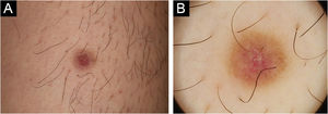 (A) Aspecto clínico do nódulo acastanhado com depressão central. (B) Dermatoscopia mostrando mancha central avermelhada com descamação branco‐amarelada circundada por rede pigmentar acastanhada.