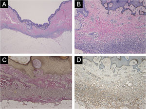 (A) Lesão com depressão central evidenciando adelgaçamento dérmico (Hematoxilina & eosina, 40×). (B) Maior ampliação mostrando proliferação de células tumorais fibroblásticas na derme e hiperplasia da epiderme sobrejacente (Hematoxilina & eosina, 200×). (C) Diminuição das fibras elásticas na derme adelgaçada (coloração para fibras elásticas de van Gieson, 200×). (D) Expressão acentuada de MMP‐2 nas células tumorais fibroblásticas (200×).