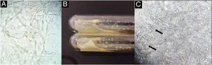 (A) Micológico direto com hifas. (B) Exame cultural com colônias ocres. (C) Aspecto microscópico da cultura com hifas e clamidoconídios arredondados em linha (setas).