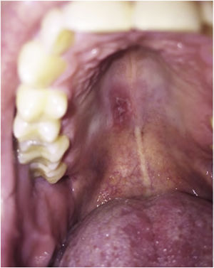 Candidíase oral com uso de anti‐IL17.