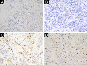 (A) HMB‐45 negativo (200×). (B) P16 negativo (200×). (C) Ciclina D1 positivo (200×). D, Ki‐67 (cerca de20%) posivito (200×).