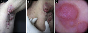 (A) Imagem clínica mostrando múltiplos nódulos de cor da pele na região axilar direita. (B) A mesma lesão, algumas semanas após a apresentação inicial. (C) Dermatoscopia dos nódulos axilares evidenciando vasos irregulares.