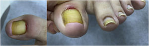 Ausência de crescimento da placa ungueal em virtude de perda completa da união da prega proximal.
