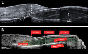 (A) Ultrassonografia cutânea de alta resolução com Doppler realizada com transdutor de 22 Mhz mostrou espessamento do leito ungueal com aspecto hipoecoico; media 4,4mm e não apresentava sinais de hipervascularização ao exame Doppler, mas apresentava redução do espaço entre a origem da lâmina ungueal e a base da falange distal – a medida era de aproximadamente 3,5mm e apresentava halo inflamatório hipoecoico. (B) Anatomia normal da unha.