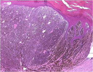 Histopatologia mostrando proliferação de melanócitos atípicos na derme (100×).