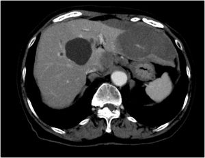 A tomografia computadorizada abdominal mostrou ruptura das metástases hepáticas.
