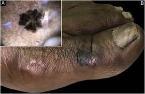 (A) Melanoma acral: aspecto dermatoscópico. (B) Mácula enegrecida no hálux.