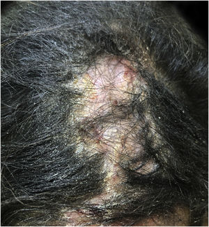 Lúpus eritematoso discoide: placa alopécica atrófica na região frontoparietal.