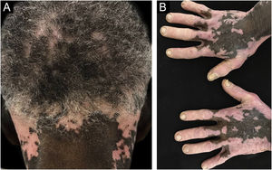 Vitiligo: máculas acrômicas no couro cabeludo e pescoço (A) e no dorso das mãos (B).
