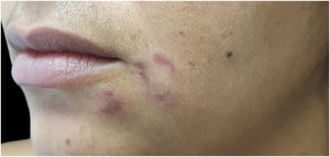 Sifílide elegante: pápula eritematosa e placa anular na face.