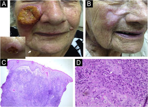 Caso 1. (A) Grande úlcera com borda infiltrativa sobre base eritêmato-violácea na região malar. A inserção (canto esquerdo) mostra a lesão mandibular (seta branca). (B) Remissão completa das lesões após tratamento com antimoniato de meglumina e anfotericina B. (C) Histopatologia da biopsia da úlcera malar mostrando hiperplasia pseudoepiteliomatosa e extenso infiltrado inflamatório granulomatoso na derme (Hematoxilina & eosina, 4×). (D) Observam‐se pérolas córneas (seta branca) e células escamosas atípicas (Hematoxilina & eosina, 60×).