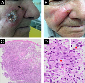 Caso 2. (A) Placa infiltrada com pequenas úlceras e crostas na região malar direita e lesão satélite na borda nasal (seta preta). (B) O paciente apresentou melhora satisfatória com 1,5g de anfotericina lipossomal. Lesão remanescente (seta branca) foi tratada com criocirurgia de sonda aberta. (C) Histopatologia mostrando hiperplasia pseudoepiteliomatosa e infiltrado granulomatoso na derme (Hematoxilina & eosina, 40×). (D) Raras estruturas ovoides no interior de macrófagos sugerindo formas amastigotas podem ser observadas (ponta de seta vermelha; Hematoxilina & eosina, 400×). A inserção (canto superior direito) mostra quatro formas amastigotas dentro de um macrófago.