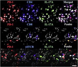 TRM (do inglês tissue‐resident memory) expressam PD‐1 na psoríase. PD‐1 e IL‐17A foram marcados conjuntamente com CD4, CD8 ou TCRγδ. Pontas de seta brancas indicam células triplamente marcadas e uma seta branca inteira indica células T CD8 IL‐17A‐PD‐1+. Reproduzido com a permissão de ©Clearance Center. O ligante de morte celular programada‐1 atenua a inflamação psoriásica suprimindo a produção de IL‐17A a partir de células T com morte celular programada‐1 alta.