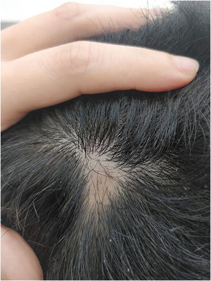 Pequena área localizada de alopecia areata. Observe o “cabelo em ponto de exclamação” no centro.
