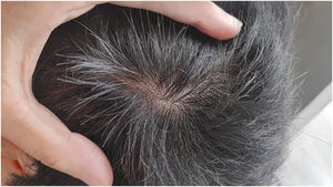 Resolução da área de alopecia areata após 16 semanas de upadacitinibe, 15mg/dia.