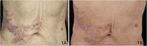(A) Pápulas metaméricas violáceas e placas infiltradas localizadas na região abdominal direita, correspondendo aos dermátomos direitos T8‐T10. B, Após quatro meses de quimioterapia, a lesão mostrou‐se mais plana e mais clara do que antes.