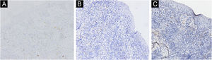 Reação imuno‐histoquímica negativa para CD20 (A), mieloperoxidase (B) e CD117 (C) (200×).