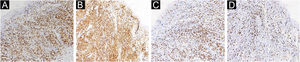 Reação imuno‐histoquímica positiva para CD3 (A), CD4 (B) e CD8 (C), Ki67 com índice de positividade superior a 30% (D) (200×).