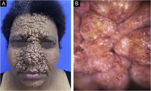 (A) Múltiplas pápulas e nódulos confluentes, normocrômicos, brilhantes, bem delimitados, de 0,5 a 2cm de diâmetro, localizados predominantemente na área central da face de maneira simétrica. (B) Dermatoscopia: vasos arboriformes, crisálidas e pseudocistos de milium sobre áreas rosadas.