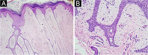 Histopatológico do caso 1 corado por hematoxilina & eosina. (A) Redes de cordões epiteliais conectados à epiderme (aumento de 20×). (B) Estroma fibrovascular entre os cordões epiteliais (aumento de 200×).