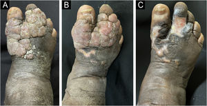 Caso 2. (A) Previamente ao tratamento. (B) Um mês após o primeiro shaving na região proximal da lesão. (C) Um mês após exérese completa.