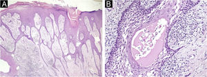 Histopatológico corado por hematoxilina & eosina do caso 2. (A) Redes de cordões epiteliais conectados à porção inferior da epiderme (aumento de 20×). (B) Lúmen do ducto écrino no interior do cordão epitelial (aumento de 400×).