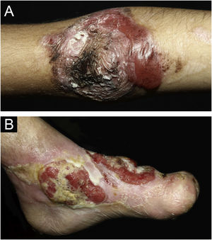 (A) Nevo da epidermólise bolhosa (nevo EB) no cotovelo, em paciente com EBDR. (B) Extensa área com exulceração e lesões de aspecto vegetante, com transformação para carcinoma espinocelular (CEC) no pé.