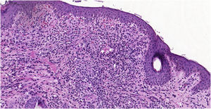 Exame histopatológico mostrando intenso infiltrado histiocitário na derme superficial até porção média da derme reticular.