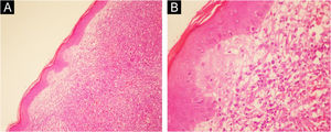 (A) Infiltração difusa na derme por células atípicas. (B) Infiltração na derme por células grandes, pouco diferenciadas, sugestivas de plasmócitos – (aumento das imagens A. 100x; B. 200x).