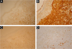 (A) C138 positivo intenso difuso nas células tumorais. (B) Kappa positividade intensa difusa na lesão. (C) CD79A positivo focal. (D) CD79A positivo focal – (aumento das imagens A.100x; B. 200x; C. 100x; D. 400x).