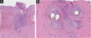 (A) Nos cortes verticais, observa‐se infiltrado linfo‐histiocitário com neutrófilos em distribuição perivascular e perianexial, e fibrose na derme. (B) Nos cortes horizontais, há infiltrado linfo‐histiocitário perifolicular com neutrófilos, principalmente nas zonas superiores do folículo e fibrose interfolicular e perifolicular concêntrica, com ausência de glândulas sebáceas. As colorações pelos métodos do PAS e de Giemsa não evidenciaram microrganismos nessas amostras (Hematoxilina & eosina, 40×[A]; 100×[B]).