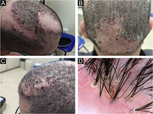 Exame clínico (A, B e C) e tricoscopia (D) antes do tratamento com adalimumabe.