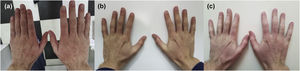 (a) Eritema e pápulas eritematosas na face dorsal das mãos. (b) Face dorsal das mãos sem lesões cutâneas. (c) Eritema na face dorsal das mãos.