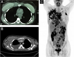 (A–B) Coleção líquida circundando o implante mamário direito, com aumento de partes moles na articulação condroesternal, definição deficiente dos planos peitorais em sua porção medial e trabeculação de tecido adiposo subcutâneo. (C) Múltiplas linfadenomegalias foram observadas no mediastino anterior e bilateralmente nas regiões axilares e fossas supraclaviculares.