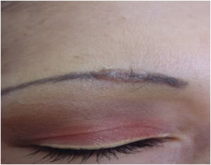 Lesões papulonodulares após tatuagem cosmética nas sobrancelhas. O diagnóstico final foi sarcoidose. Arquivo fotográfico do Serviço de Dermatologia da Universidad de Antioquia.